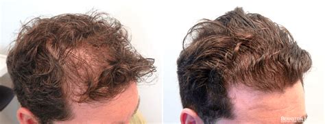 finasteride results 6 months|Propecia Rogaine Before After Photos .